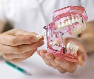 a dentist holding a model of a dental implant bridge