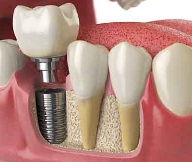 a 3D depiction of a dental implant in the jawbone