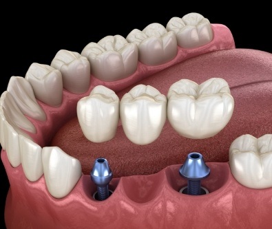 Animated two dental implants with dental bridge