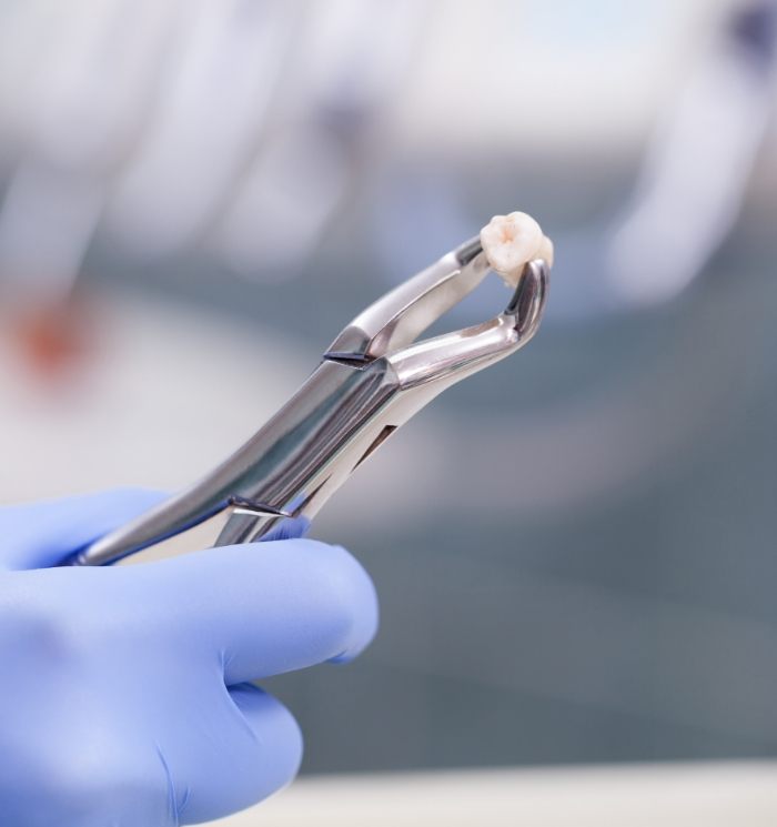 Dental forceps holding an extracted tooth