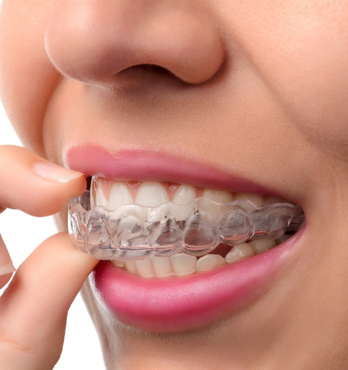 Closeup of a Sure Smile aligner